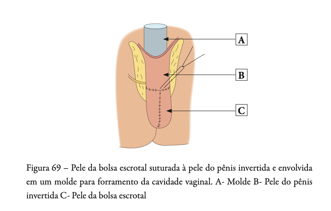 Transgender DILATAÇÃO EM REDESIGNAÇÃO SEXUAL